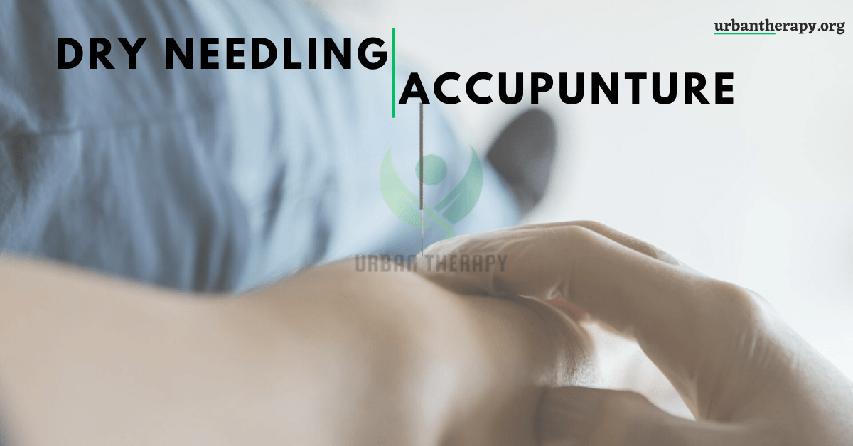 Dry Needling vs Accupunture